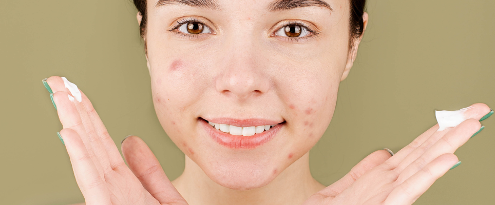 Signs Your Acne Is Hormonal
